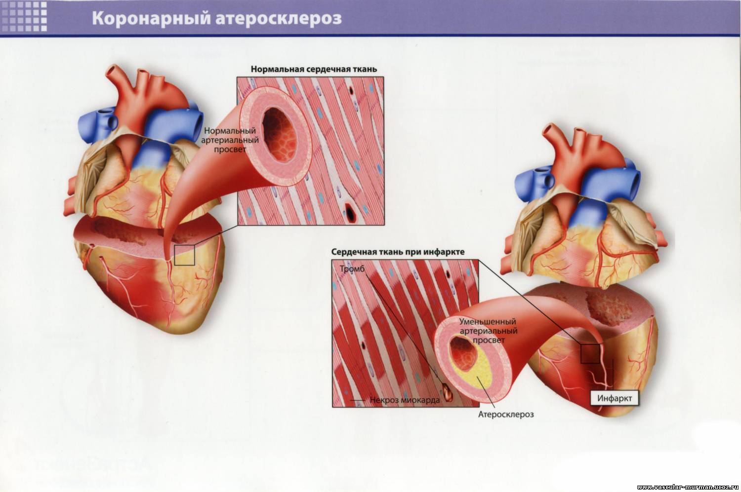Ишемическая болезнь сосудов. Атеросклероз венечных артерий сердца. Атеросклеротическое поражение коронарных артерий. Что такое коронарный артериальный атеросклероз. ИБС атеросклероз коронарных артерий.